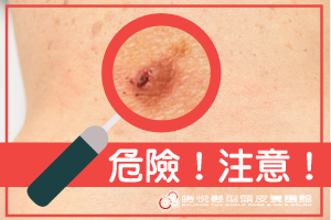 從沒注意過？這幾個地方有痣，一定要當心注意！